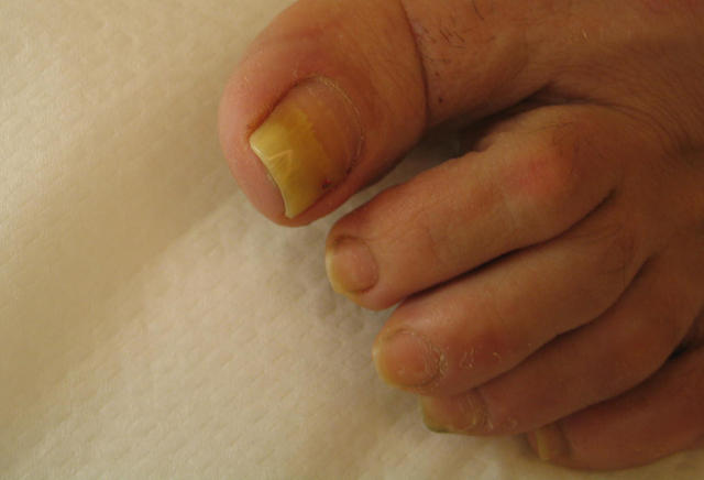 NAIL DISEASES - Onychomycosis