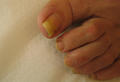 NAIL DISEASES - Onychomycosis