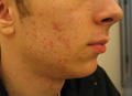 DISEASES OF THE SEBACEOUS GLANDS - Acne, inflammatory of the face