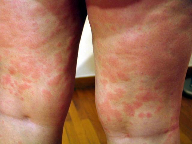 URTICARIA - Urticaria