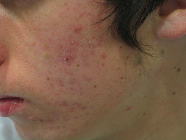 DISEASES OF THE SEBACEOUS GLANDS - Acne, inflammatory of the face DISEASES OF THE SEBACEOUS GLANDS - Acne, inflammatory of the face