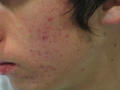 DISEASES OF THE SEBACEOUS GLANDS - Acne, inflammatory of the face