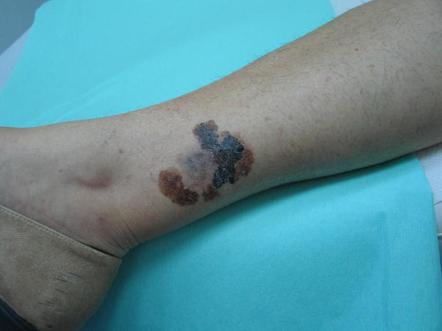 MALIGNANT LESIONS - Melanoma