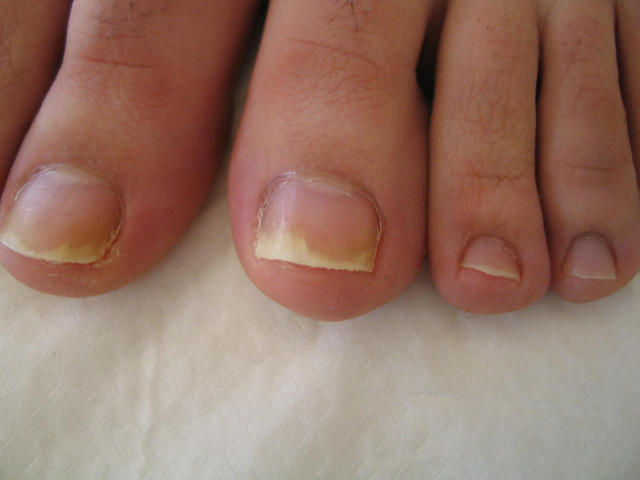 NAIL DISEASES - Onychomycosis