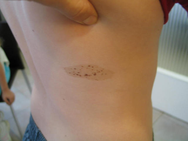 BENIGN SKIN LESIONS, NEVI, CYSTS - Naevus, naevocytic BENIGN SKIN LESIONS, NEVI, CYSTS - Naevus, naevocytic
