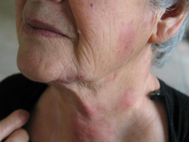 VIRAL INFECTIONS - Herpes Zoster VIRAL INFECTIONS - Herpes Zoster