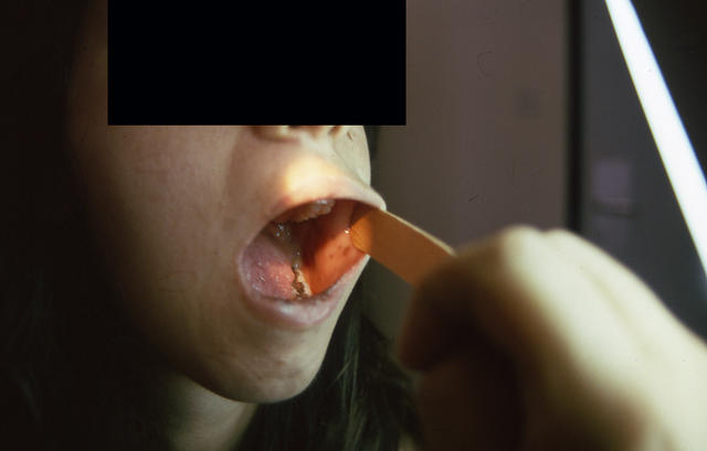 PIGMENTATION DISORDERS - Peutz - Jeghers syndrome PIGMENTATION DISORDERS - Peutz - Jeghers syndrome