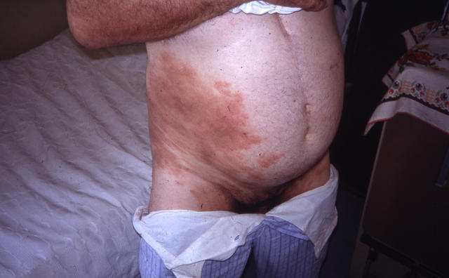 LYMPHOMAS - LYMPHOCYTIC INFILTRATIONS - Mycosis Fungoides LYMPHOMAS - LYMPHOCYTIC INFILTRATIONS - Mycosis Fungoides