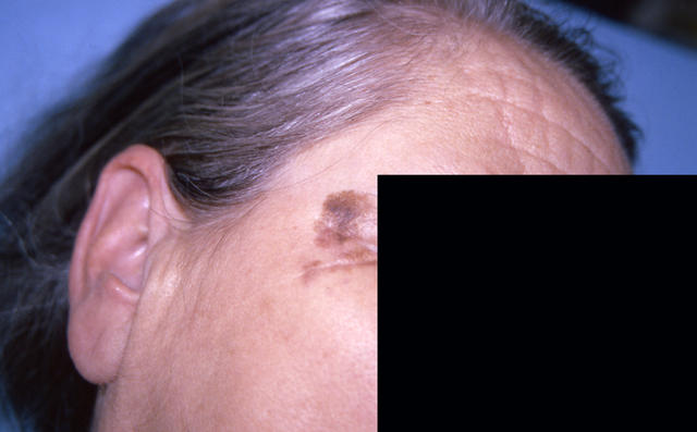 MALIGNANT LESIONS - Lentigo Maligna Melanoma MALIGNANT LESIONS - Lentigo Maligna Melanoma