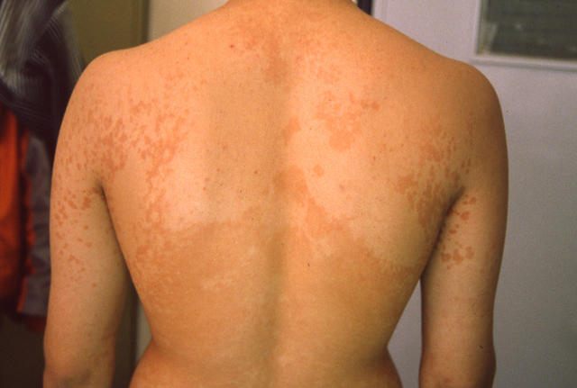 SUPERFICIAL FUNGAL INFECTIONS - Pityriasis versicolor