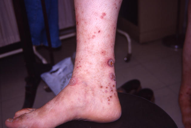 PARASITOSES, BITES - Insect bites PARASITOSES, BITES - Insect bites