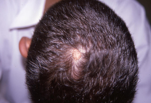 HAIR DISEASES - Alopecia cicatricial