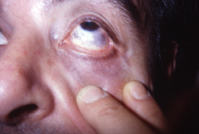 PIGMENTATION DISORDERS - Naevus of Ota