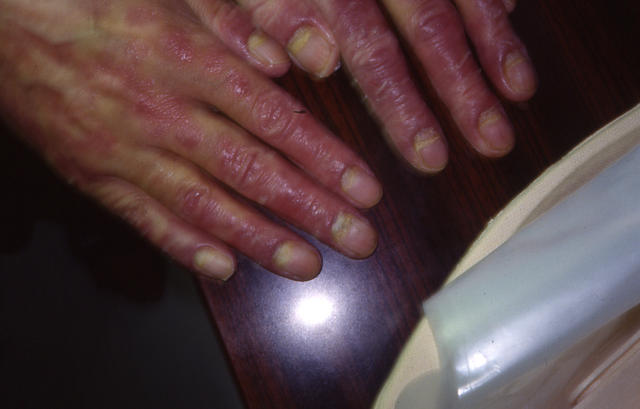 PSORIASIS - Psoriasis PSORIASIS - Psoriasis
