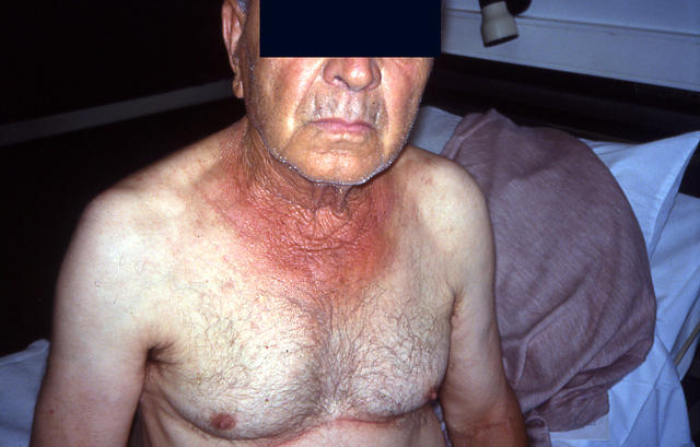 AGEING, PHOTOAGEING - Solar elastosis AGEING, PHOTOAGEING - Solar elastosis