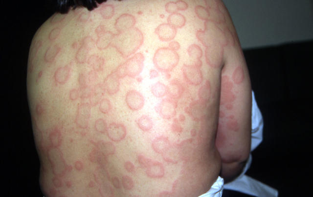 URTICARIA - Urticaria URTICARIA - Urticaria