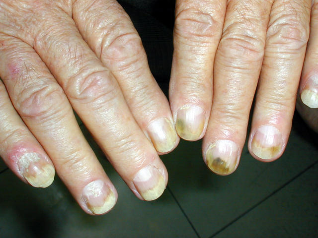 PSORIASIS - Psoriatic nails