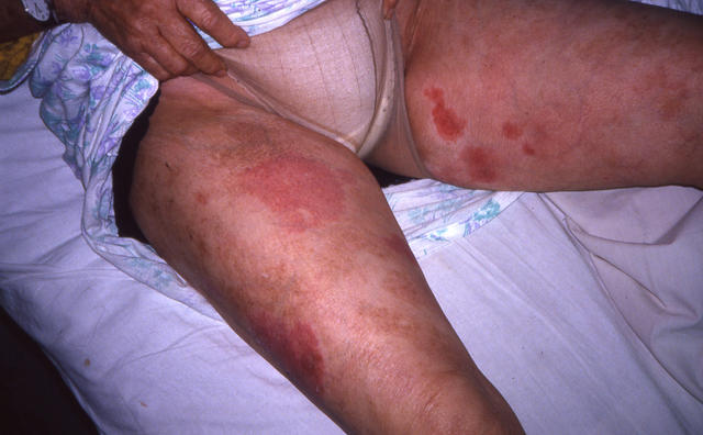 LYMPHOMAS - LYMPHOCYTIC INFILTRATIONS - Mycosis Fungoides LYMPHOMAS - LYMPHOCYTIC INFILTRATIONS - Mycosis Fungoides