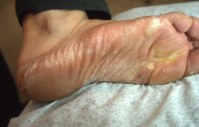 SUPERFICIAL FUNGAL INFECTIONS - Tinea pedis (Athlet's foot)