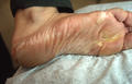 SUPERFICIAL FUNGAL INFECTIONS - Tinea pedis (Athlet