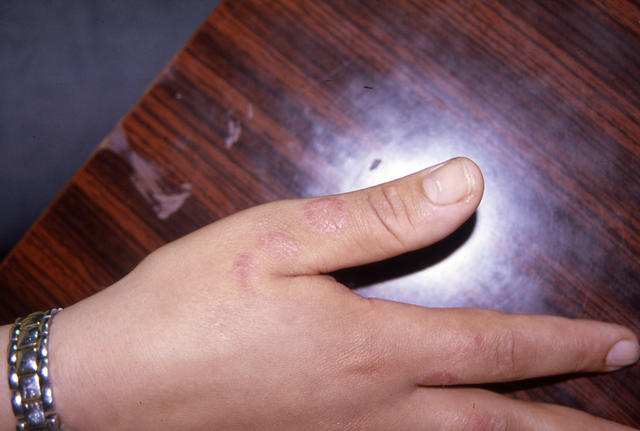 NECROBIOTIC DISORDERS - Granuloma Annulare NECROBIOTIC DISORDERS - Granuloma Annulare