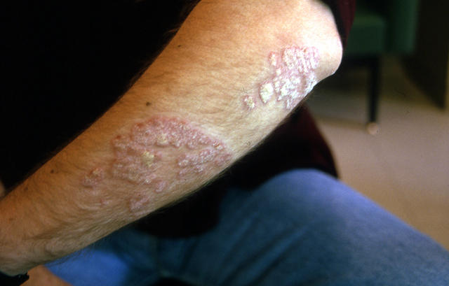 PSORIASIS - Psoriasis, Generalised 'en plaques'