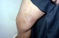 SUPERFICIAL FUNGAL INFECTIONS - Tinea corporis due to trichophyton