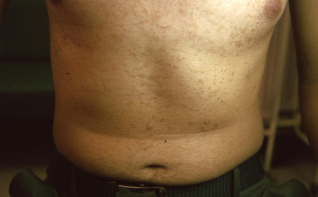 SUPERFICIAL FUNGAL INFECTIONS - Pityriasis versicolor SUPERFICIAL FUNGAL INFECTIONS - Pityriasis versicolor