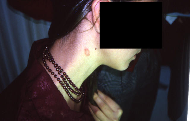 SUPERFICIAL FUNGAL INFECTIONS - Tinea infection SUPERFICIAL FUNGAL INFECTIONS - Tinea infection