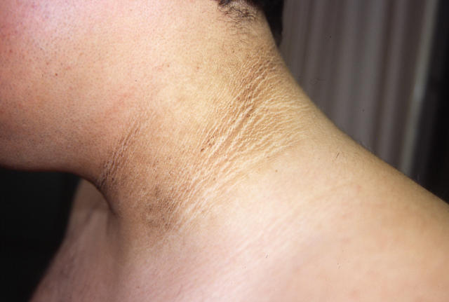 KERATINISATION DISORDERS - Acanthosis nigricans