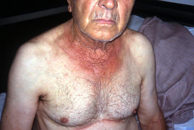 AGEING, PHOTOAGEING - Elastosis AGEING, PHOTOAGEING - Elastosis