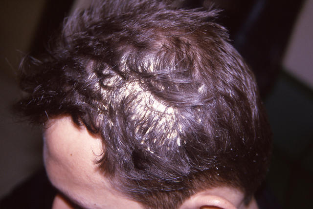 HAIR DISEASES - Pseudomonilethrix HAIR DISEASES - Pseudomonilethrix