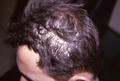 HAIR DISEASES - Pseudomonilethrix