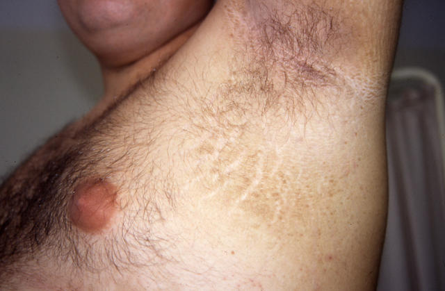 KERATINISATION DISORDERS - Acanthosis nigricans