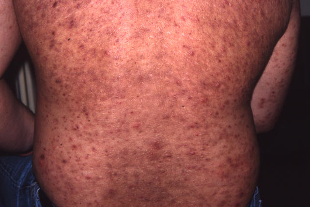 DISEASES OF THE SEBACEOUS GLANDS - Acne, inflammatory DISEASES OF THE SEBACEOUS GLANDS - Acne, inflammatory