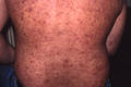 DISEASES OF THE SEBACEOUS GLANDS - Acne, inflammatory