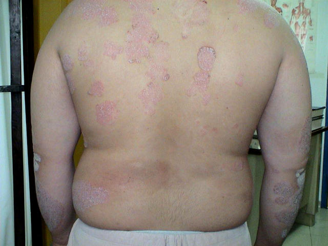 PSORIASIS - Plaque psoriasis