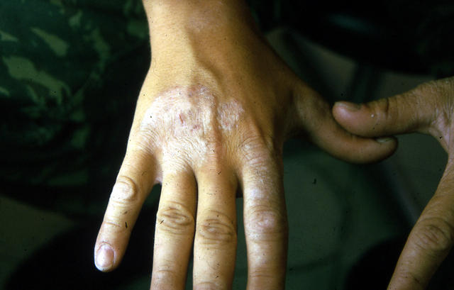 SUPERFICIAL FUNGAL INFECTIONS - Tinea, multiple lesions