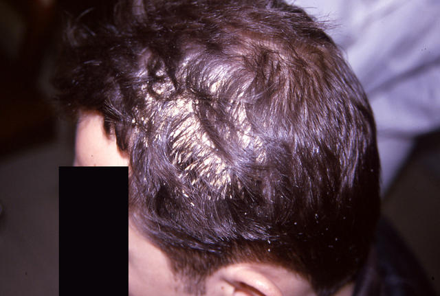HAIR DISEASES - Pseudomonilethrix HAIR DISEASES - Pseudomonilethrix