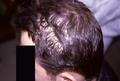 HAIR DISEASES - Pseudomonilethrix