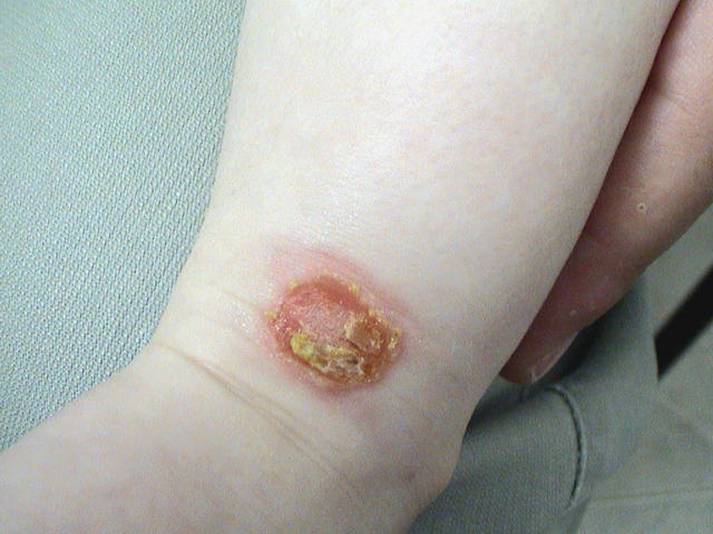 BACTERIAL INFECTIONS - Impetigo BACTERIAL INFECTIONS - Impetigo