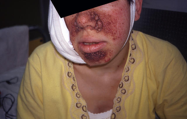 GENODERMATOSES - Tuberous sclerosis complex