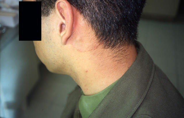 SUPERFICIAL FUNGAL INFECTIONS - Tinea infection SUPERFICIAL FUNGAL INFECTIONS - Tinea infection