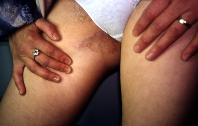 SUPERFICIAL FUNGAL INFECTIONS - Tinea cruris due to E. floccosum