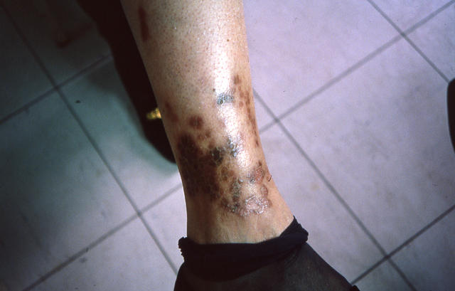 NECROBIOTIC DISORDERS - Necrobiosis lipoidica NECROBIOTIC DISORDERS - Necrobiosis lipoidica
