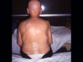PIGMENTATION DISORDERS - Vitiligo and alopecia areata