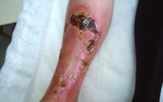 BACTERIAL INFECTIONS - Erysipelas