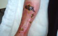 BACTERIAL INFECTIONS - Erysipelas