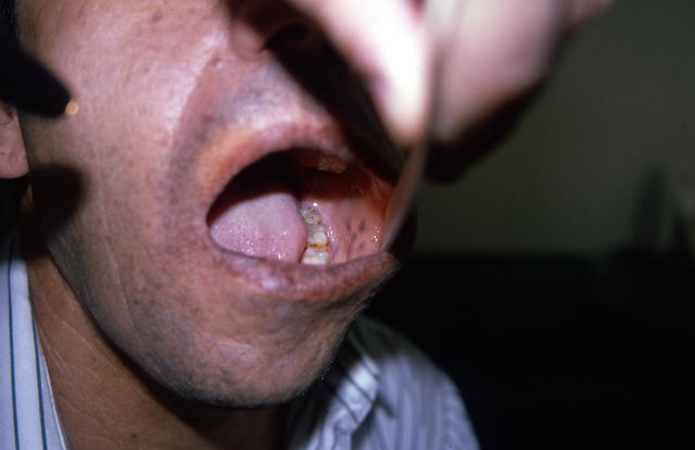 PIGMENTATION DISORDERS - Peutz - Jeghers syndrome PIGMENTATION DISORDERS - Peutz - Jeghers syndrome