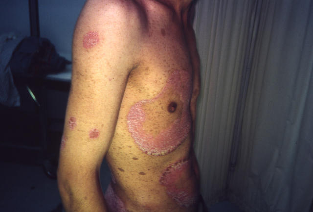 PSORIASIS - Plaque psoriasis